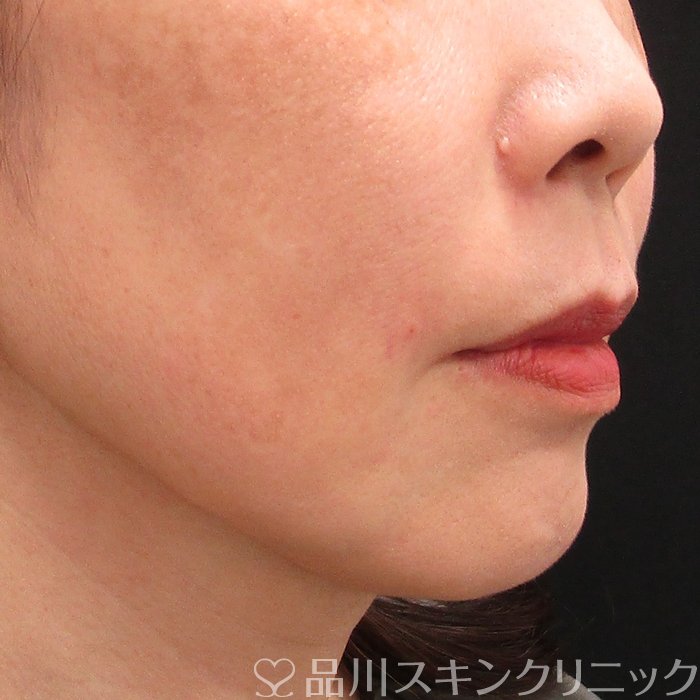 症例NO.74406のAFTER写真