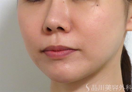 症例NO.36422のAFTER写真