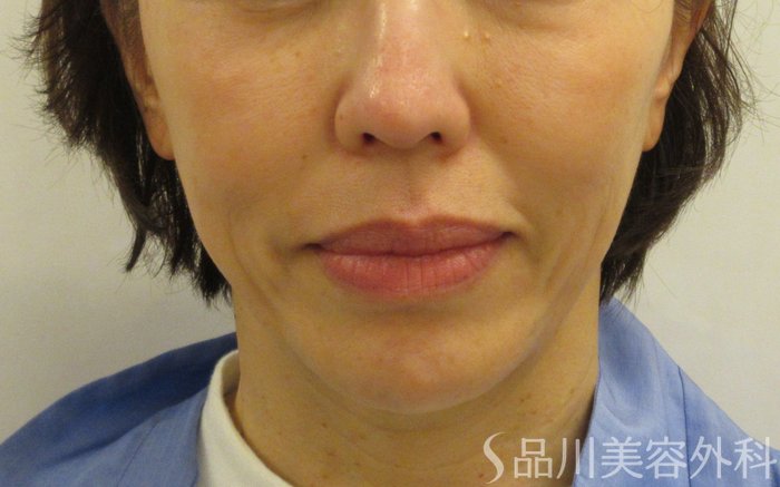 症例NO.70813のBEFORE写真