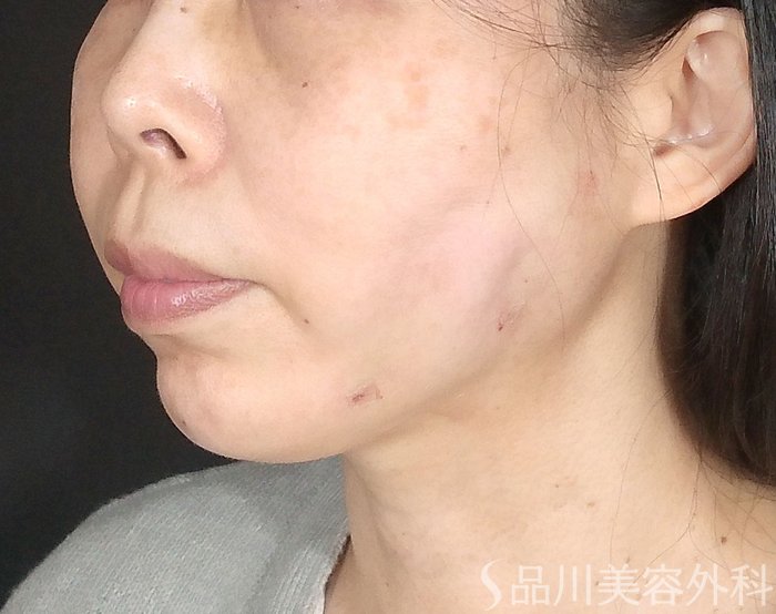 症例NO.64809のAFTER写真