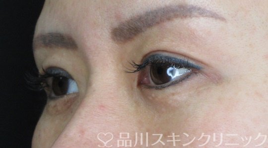 症例NO.69634のAFTER写真