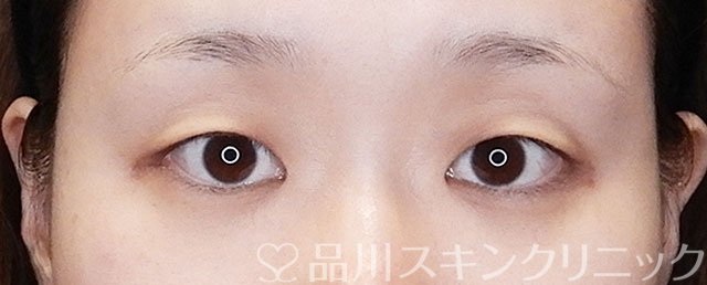 症例NO.75272のBEFORE写真