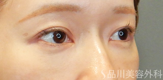 症例NO.67709のBEFORE写真