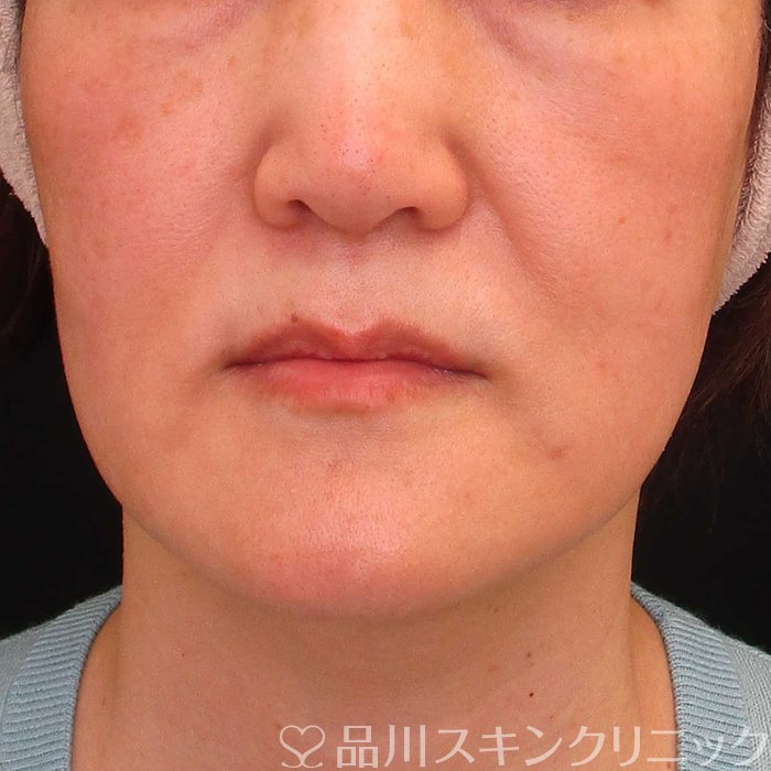 症例NO.65608のBEFORE写真