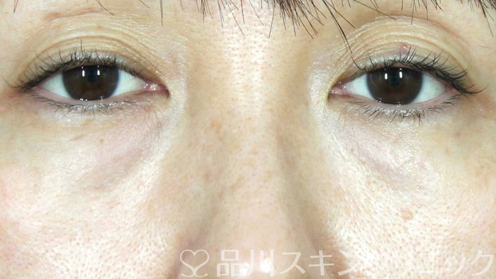 症例NO.71312のBEFORE写真