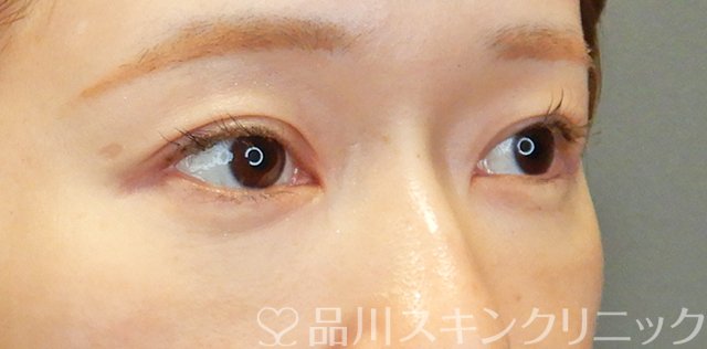 症例NO.67709のBEFORE写真