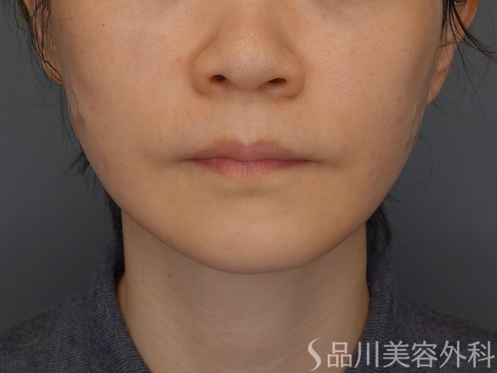 症例NO.72440のAFTER写真