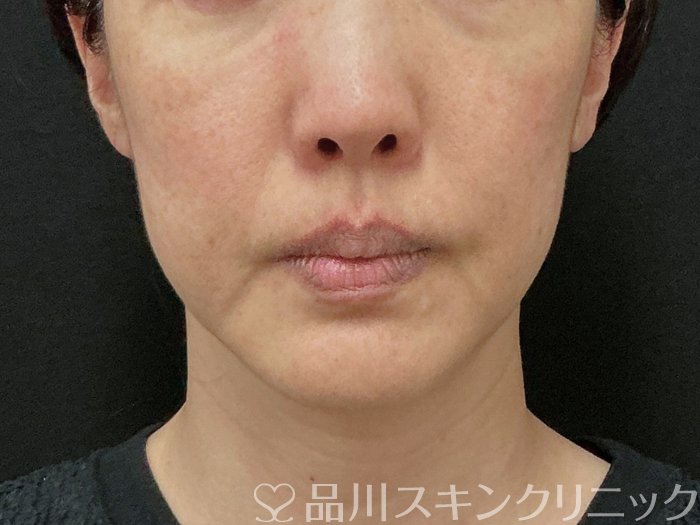 症例NO.73945のBEFORE写真