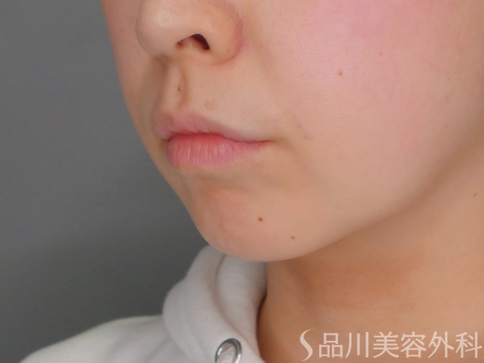 症例NO.69870のBEFORE写真