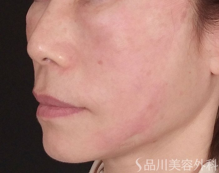 症例NO.70263のAFTER写真