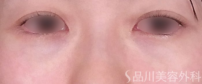 症例NO.70059のAFTER写真