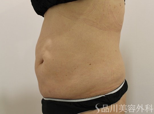 症例NO.73217のAFTER写真