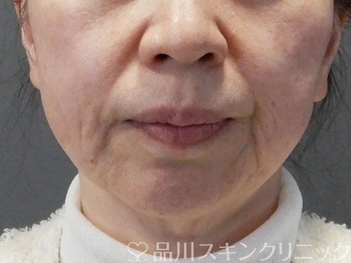 症例NO.73037のBEFORE写真