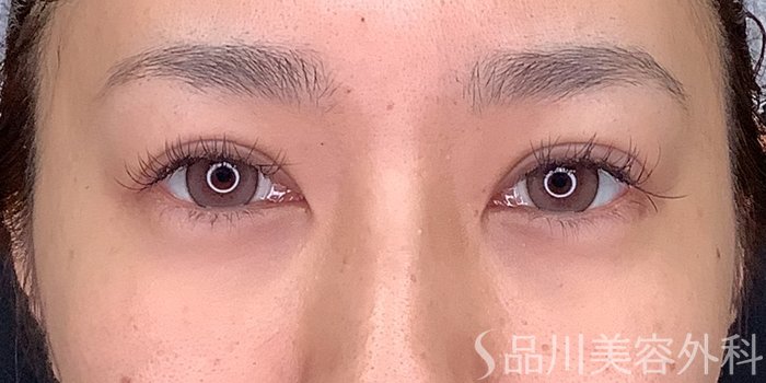 症例NO.71238のAFTER写真