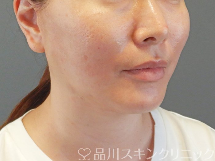 症例NO.65379のAFTER写真