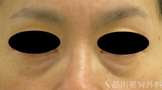 症例NO.55707のBEFORE写真
