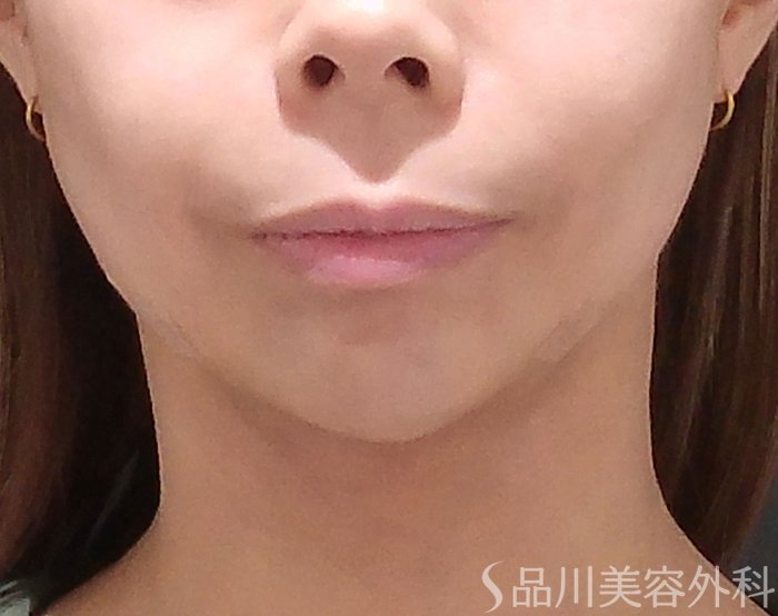症例NO.69783のAFTER写真