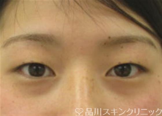 症例NO.36230のBEFORE写真