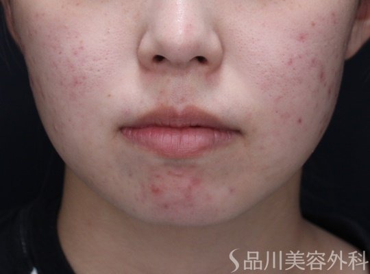 症例NO.67852のBEFORE写真