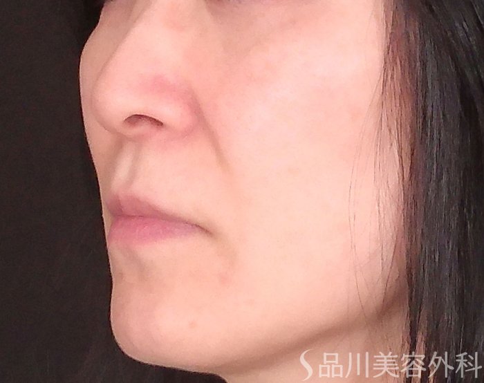 症例NO.70153のBEFORE写真