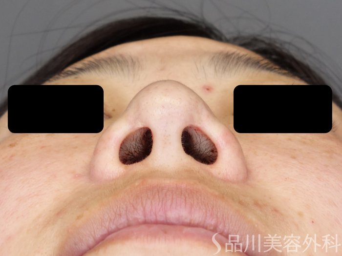 症例NO.71433のAFTER写真