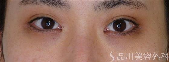 症例NO.52482のBEFORE写真