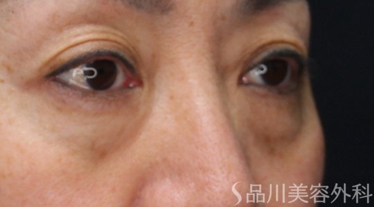 症例NO.71875のBEFORE写真