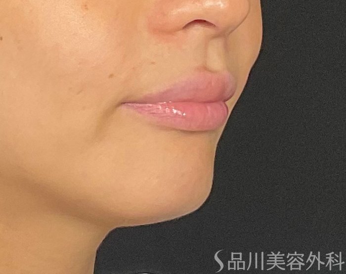 症例NO.74490のBEFORE写真