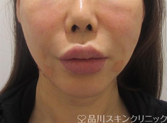 症例NO.33457のAFTER写真