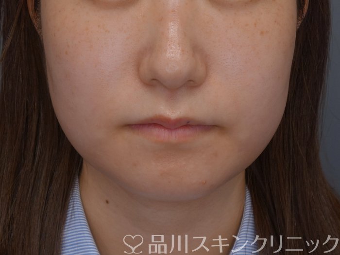 症例NO.75079のBEFORE写真