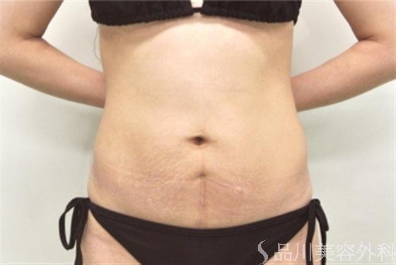 症例NO.17006のBEFORE写真