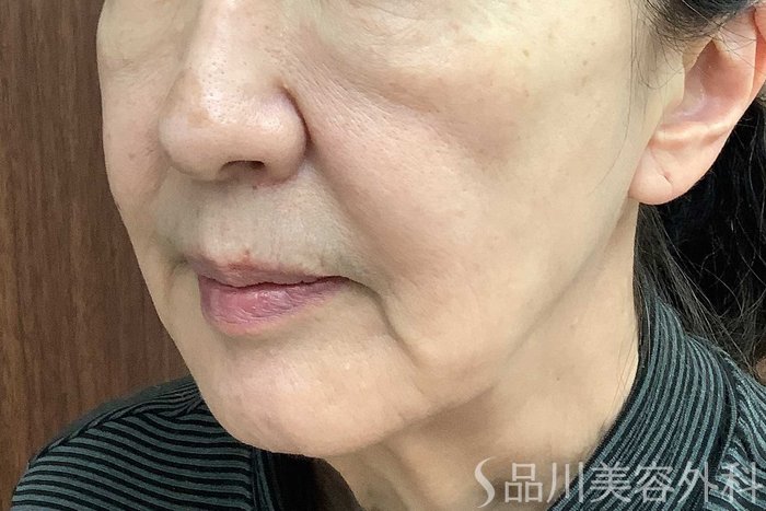 症例NO.62923のBEFORE写真