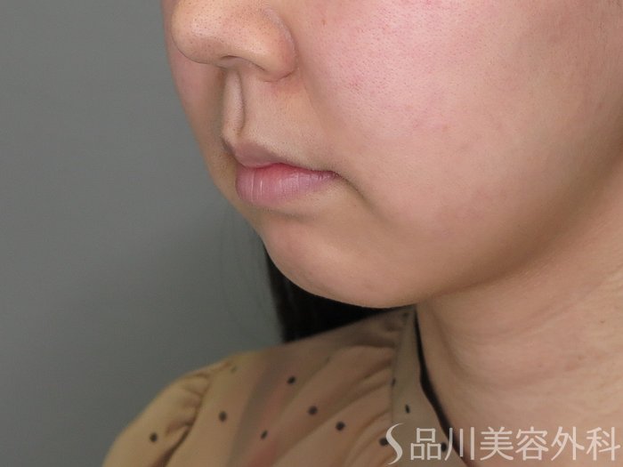 症例NO.71299のBEFORE写真