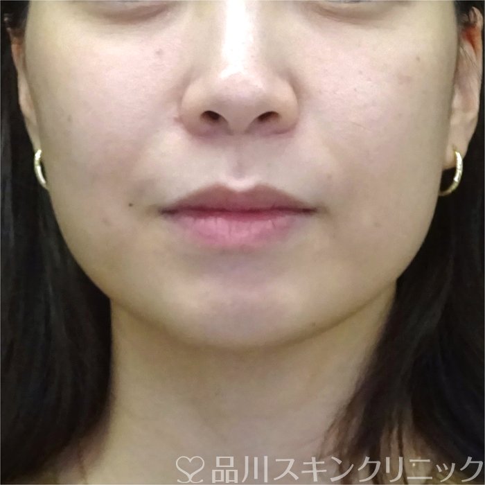 症例NO.71991のBEFORE写真