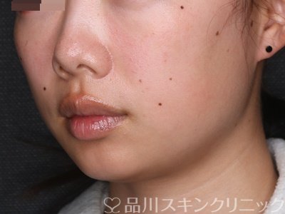 症例NO.72518のAFTER写真