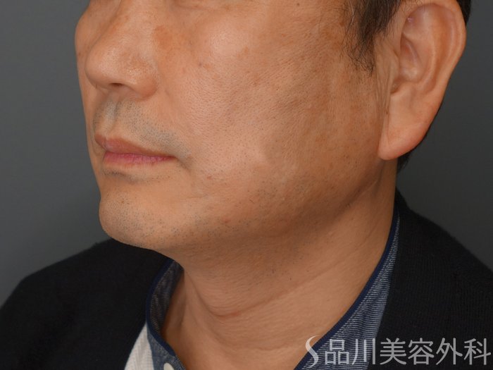 症例NO.74484のAFTER写真
