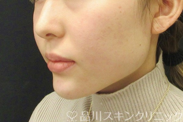 症例NO.68365のAFTER写真
