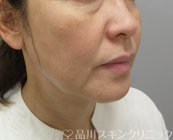 症例NO.73738のBEFORE写真