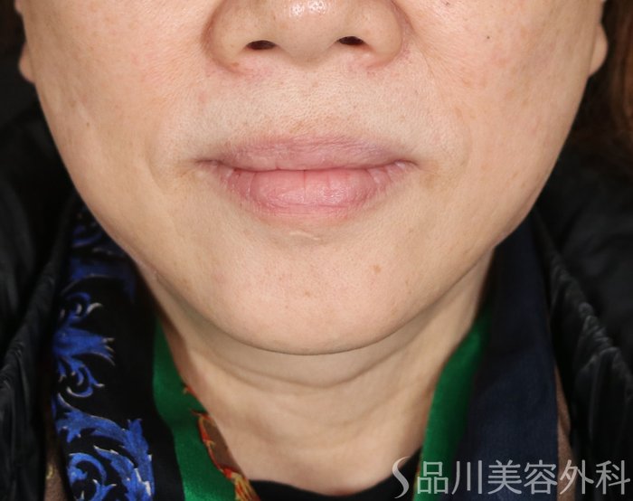 症例NO.72474のAFTER写真