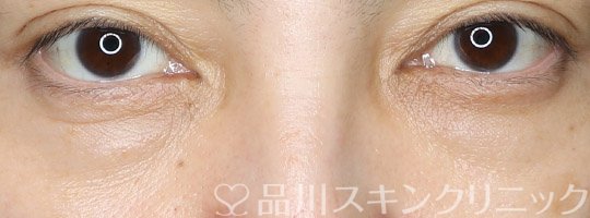 症例NO.69586のBEFORE写真