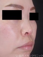 症例NO.73968のBEFORE写真