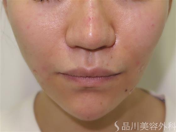 症例NO.41668のAFTER写真