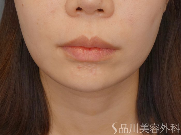 症例NO.72737のBEFORE写真