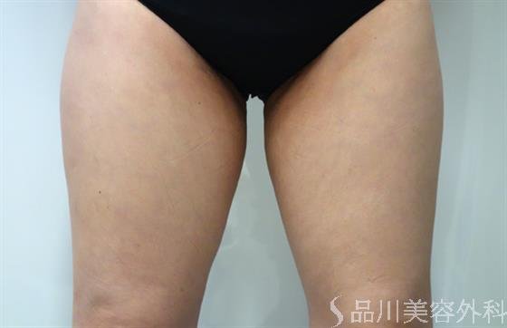 症例NO.40653のAFTER写真