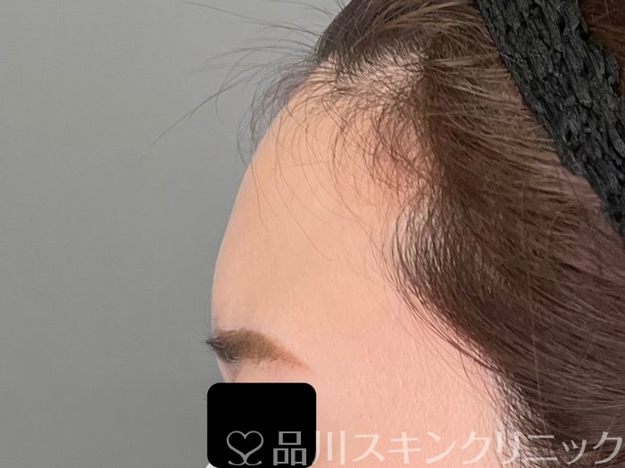 症例NO.69980のBEFORE写真