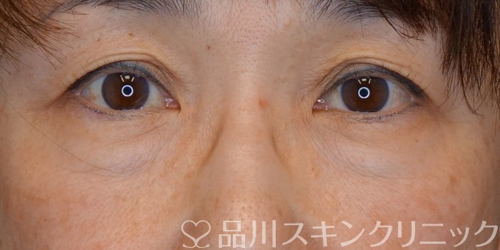 症例NO.74249のBEFORE写真