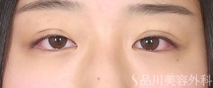 症例NO.65545のAFTER写真