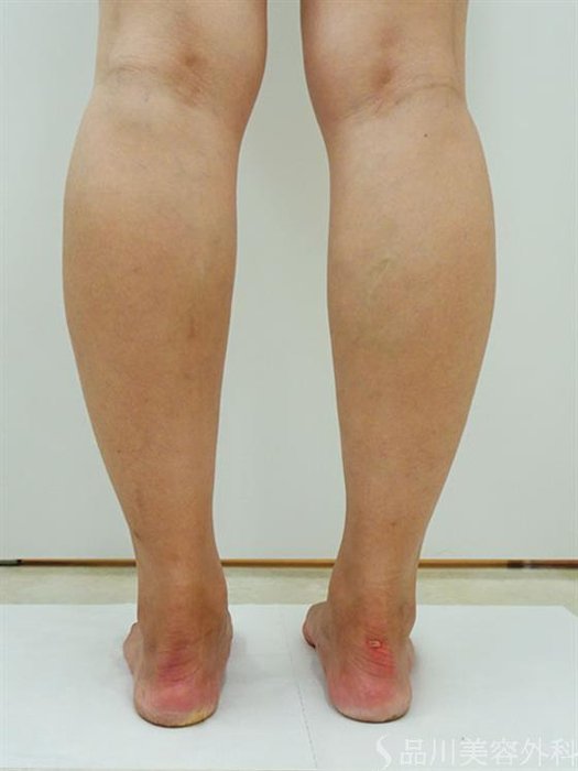症例NO.44170のAFTER写真
