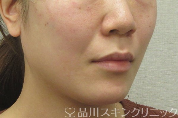 症例NO.74461のAFTER写真