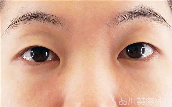 症例NO.58004のBEFORE写真